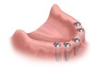 dental implants in the jawbone