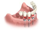 dental implant full arch replacement