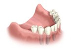 lower arch tooth replacement