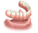 full arch dentures