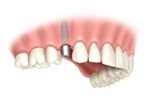 single dental implant restoration