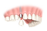 Single dental implant