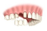 single tooth replacement dental bridges