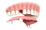 single tooth replacement implant