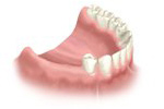 lower arch missing back molars