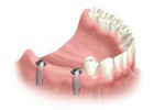 multiple tooth replacement with dental implants