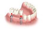 multiple tooth replacement - back molars