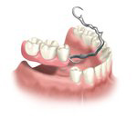 multiple tooth replacement graphic